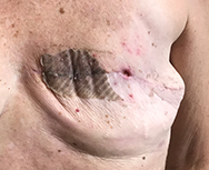 Patient with mastectomy of left breast begins Day 1 of Juven to address a lingering open wound at the incision site. Juven was added to the patient's standard wound care program.