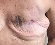 Juven, Day 7. After less than one week of initiating Juven twice per day, the wound begins to close and the needle marks are healed.