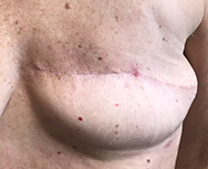 Day 28 of Juven Therapeutic Nutrition Powder. Wound is closed and wound site shows marked improvement.