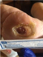 diabetic-foot-ulcer-03