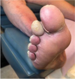 pediatry-ulcer-toe-juven-day21