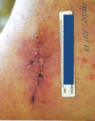 Dermatology-juven-day21-right-sholder