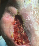 pediatry-ulcer-left-foot-image2